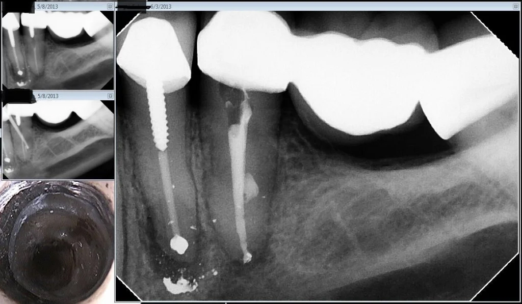 Hackensack Endodontic Retreatment