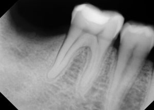 Root Canals near Hackensack