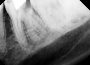 Endodontics near Hackensack