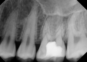 Root Canals near Hackensack